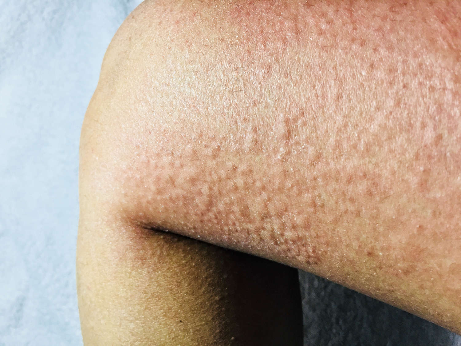 Orticaria da freddo sulla gamba