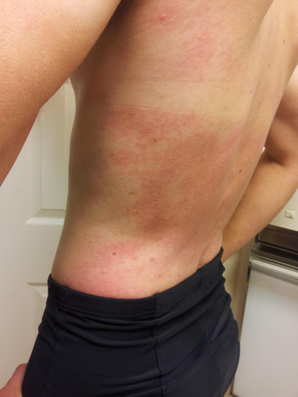 Orticaria da freddo sulla schiena