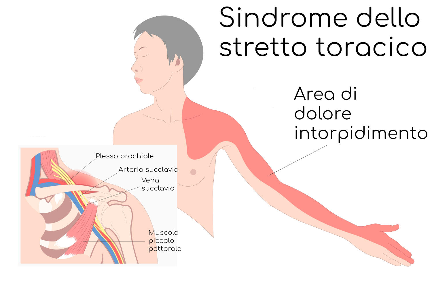 Sindrome dello stretto toracico