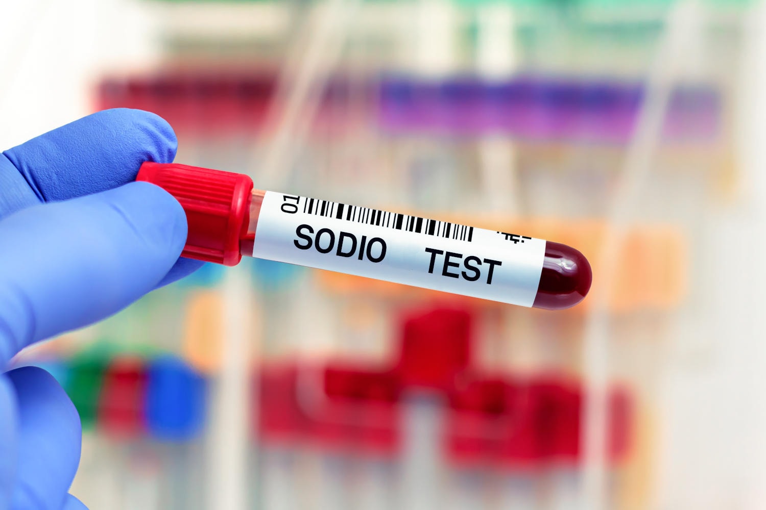 Concentrazione del sodio nel sangue