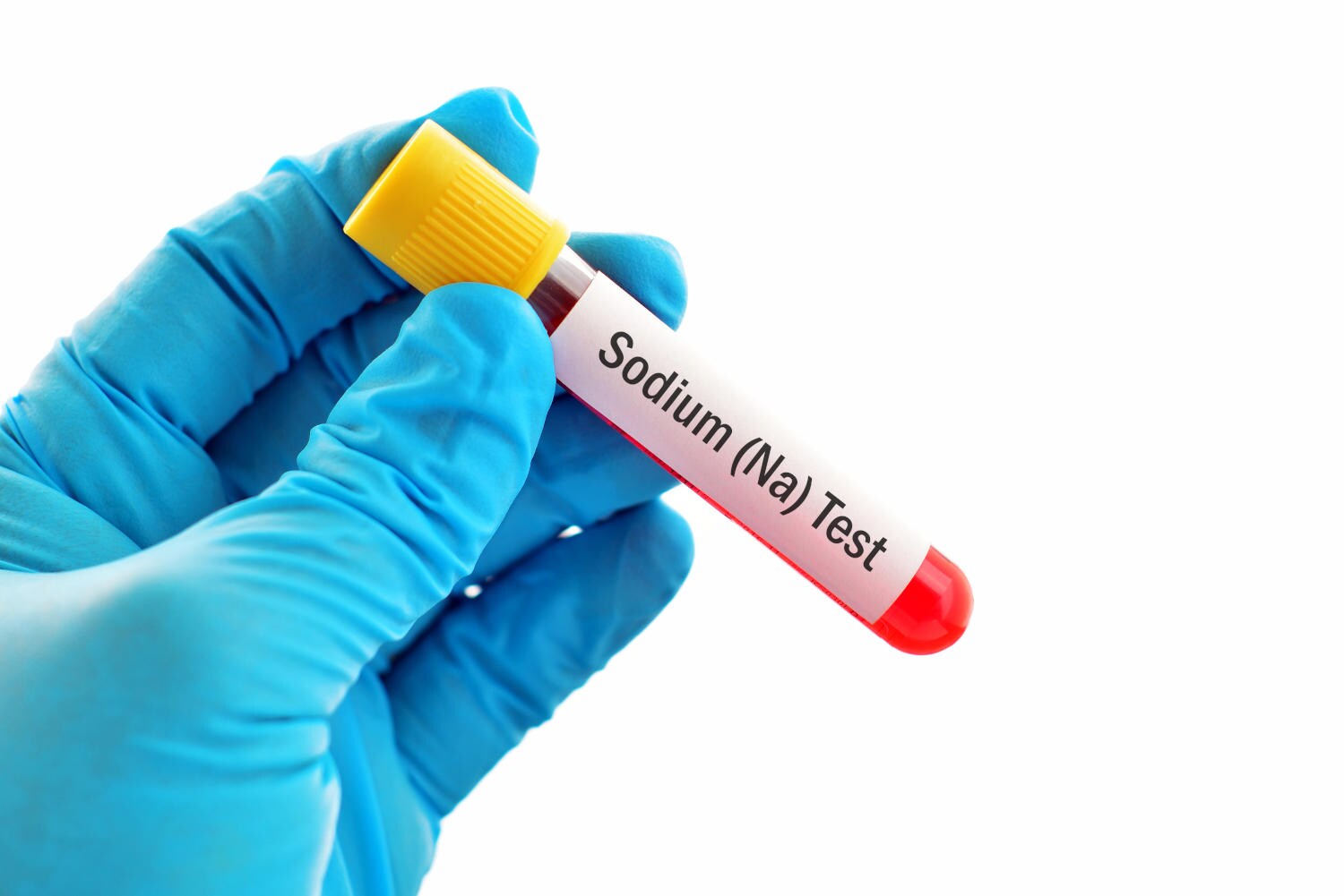Provetta di sangue con la scritta sodio