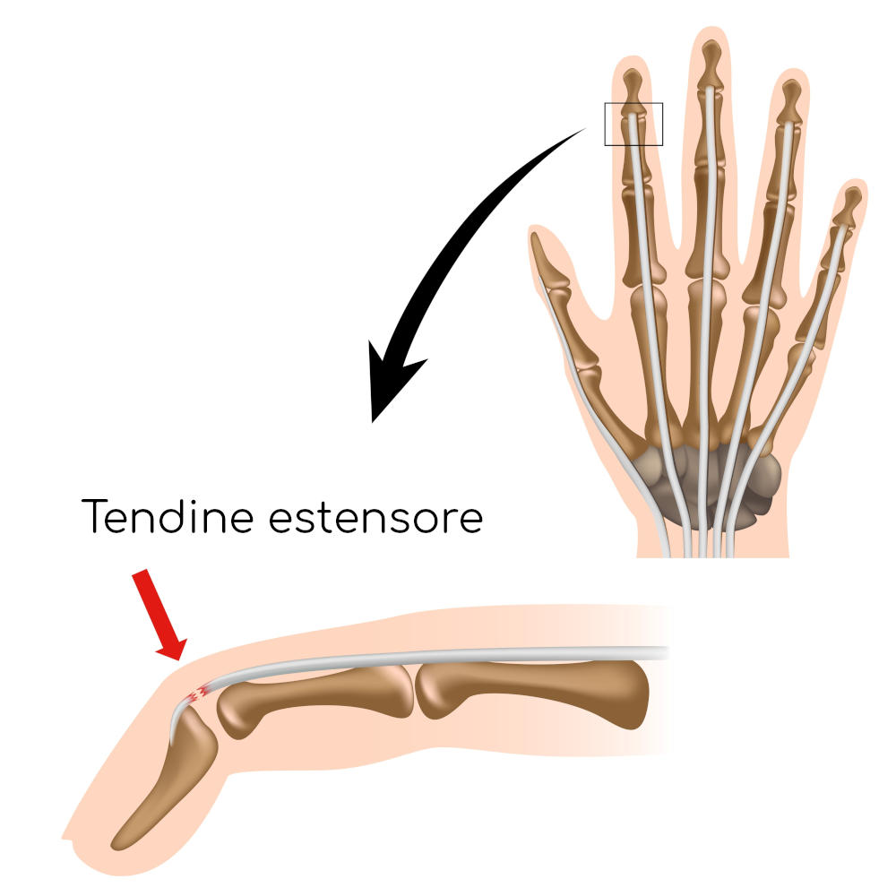 Tendine estensore del dito