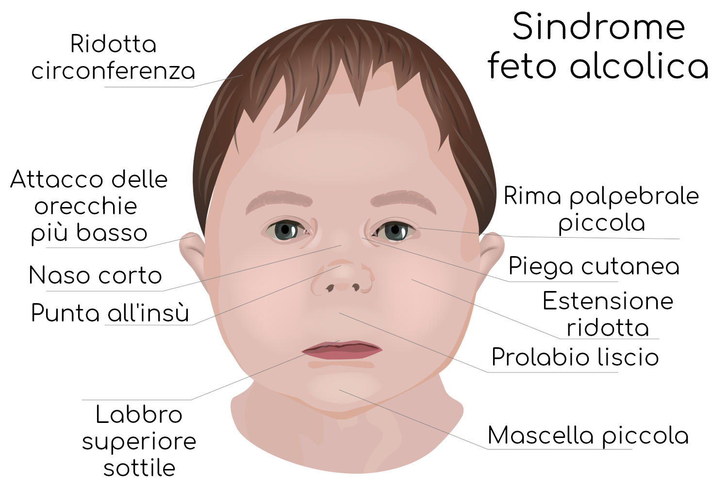 Sindrome feto alcolica