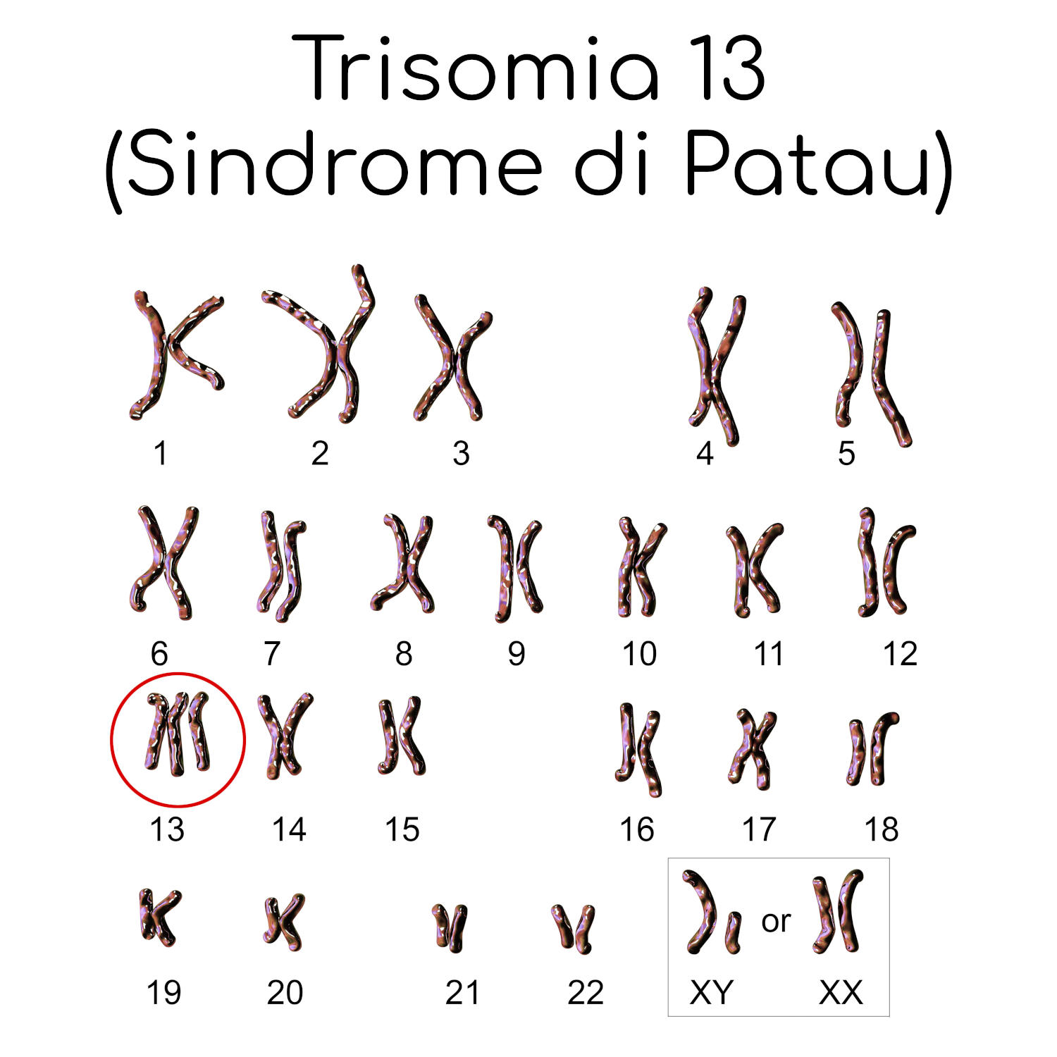 Sindrome di Patau