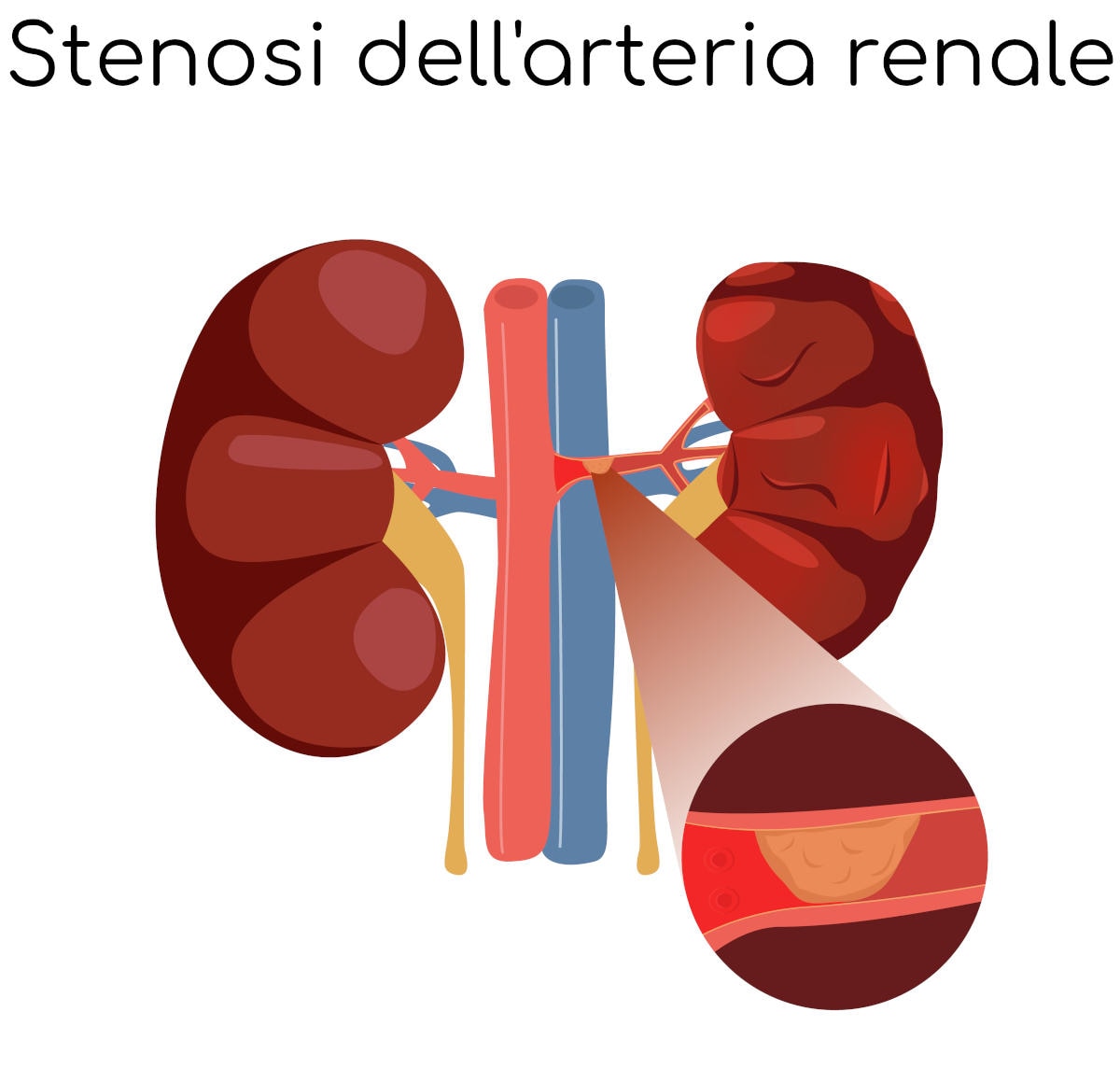 Stenosi dell'arteria renale