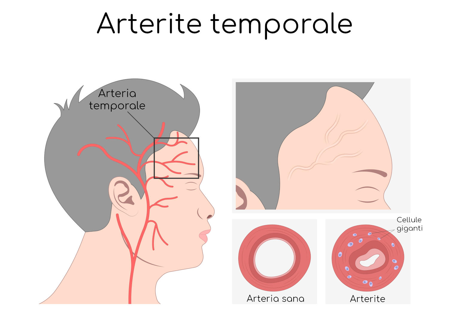 Arterite temporale