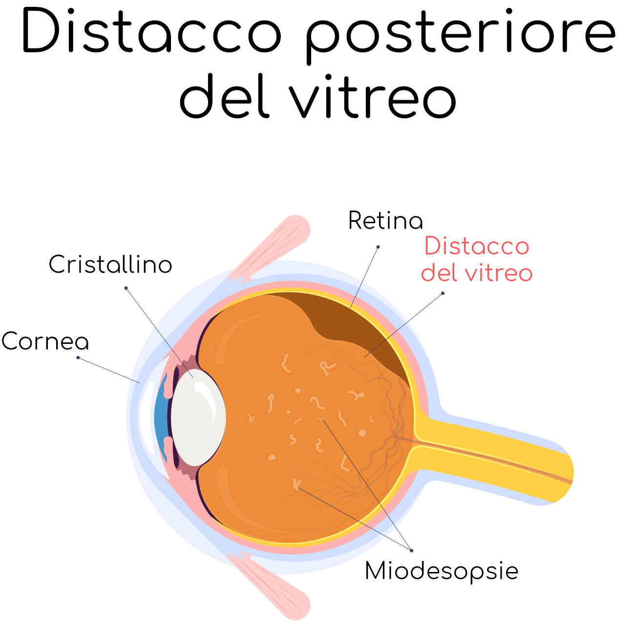 Distacco posteriore del vitreo