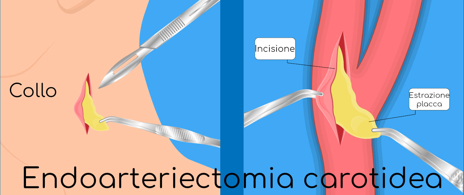 Endoarteriectomia carotidea