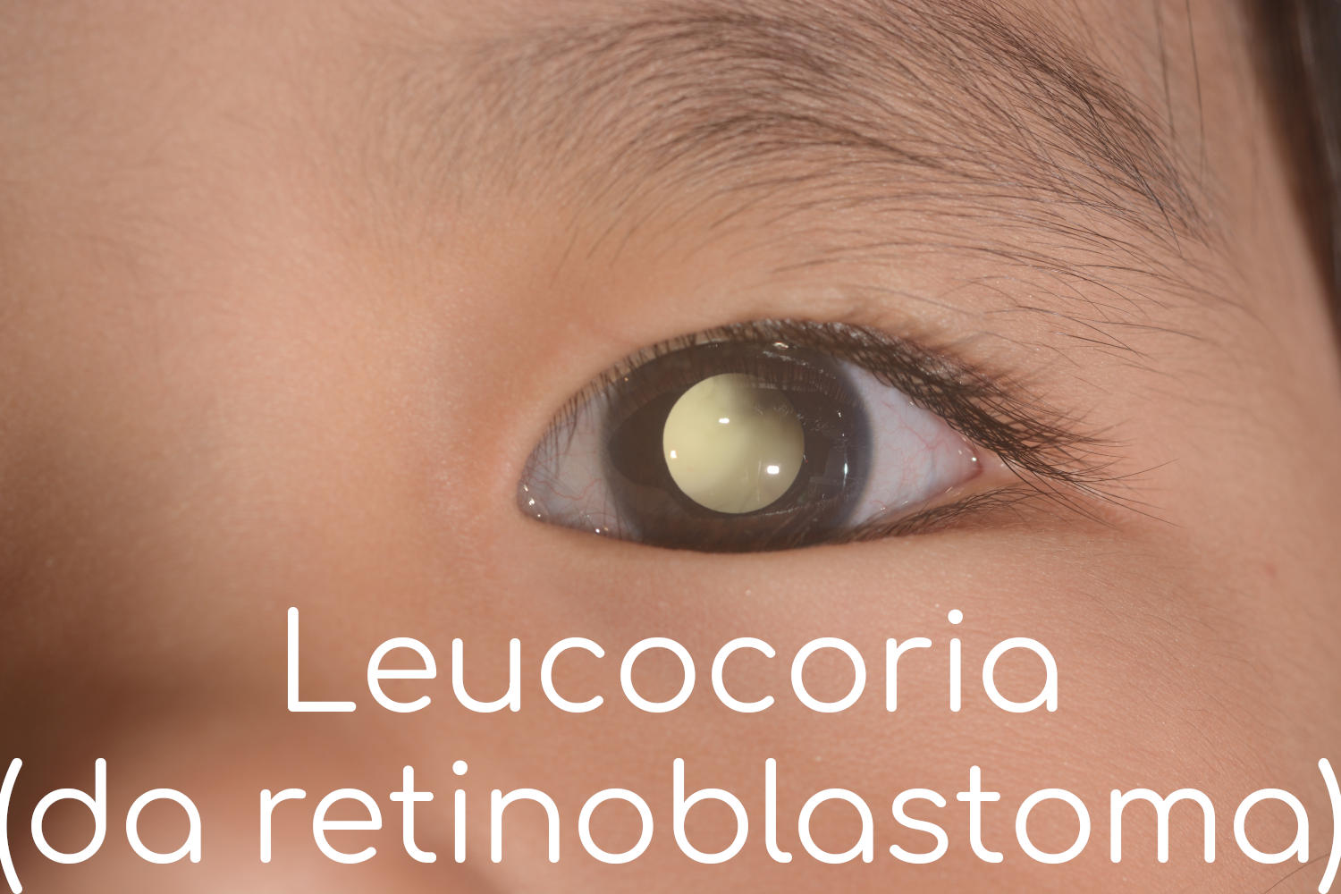 Leucocoria da retinoblastoma