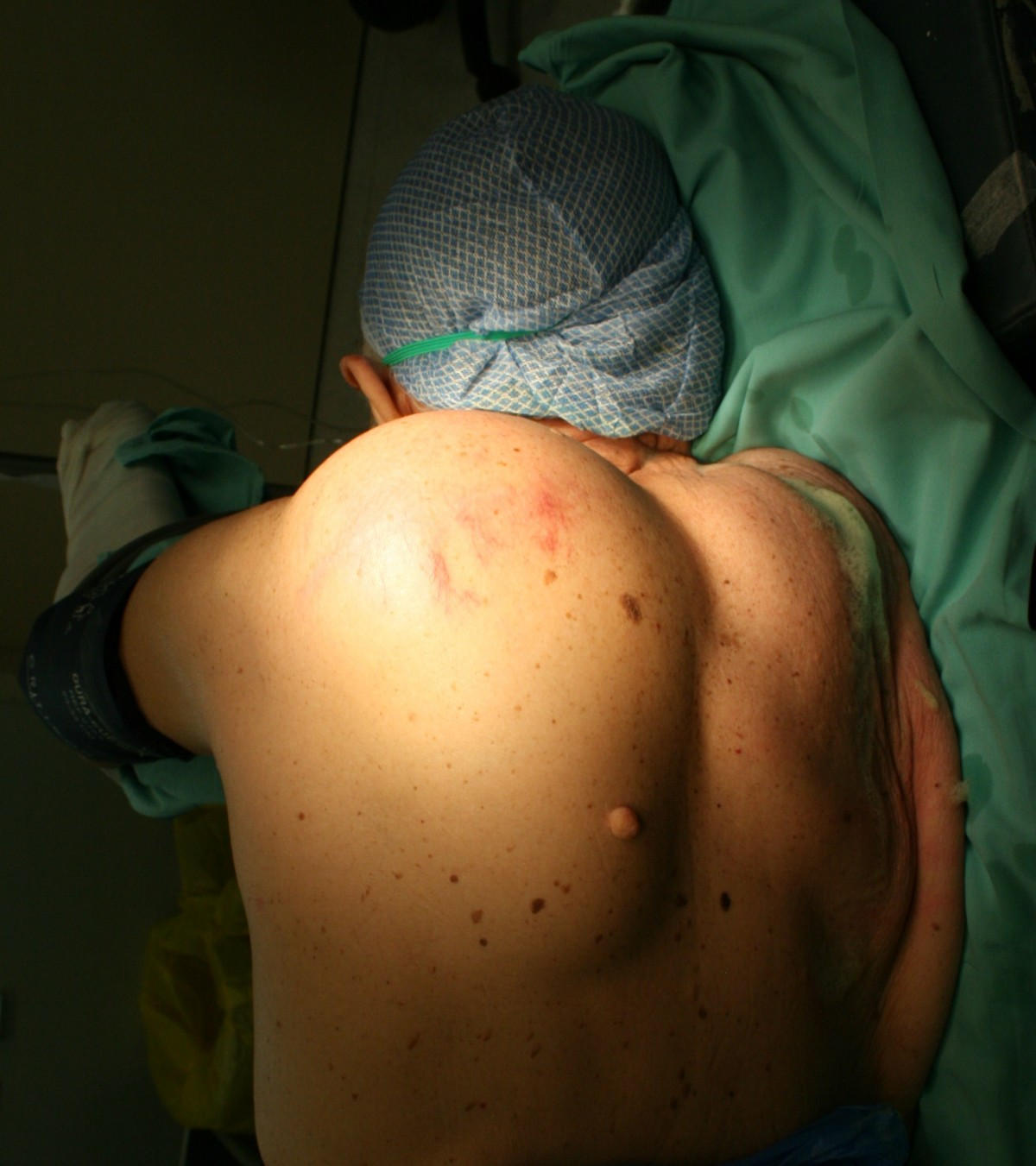 Liposarcoma sulla schiena