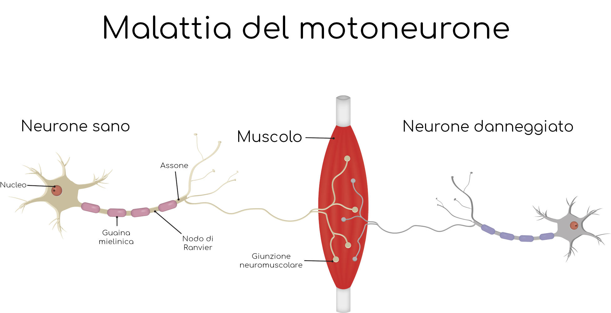 Malattia del motoneurone