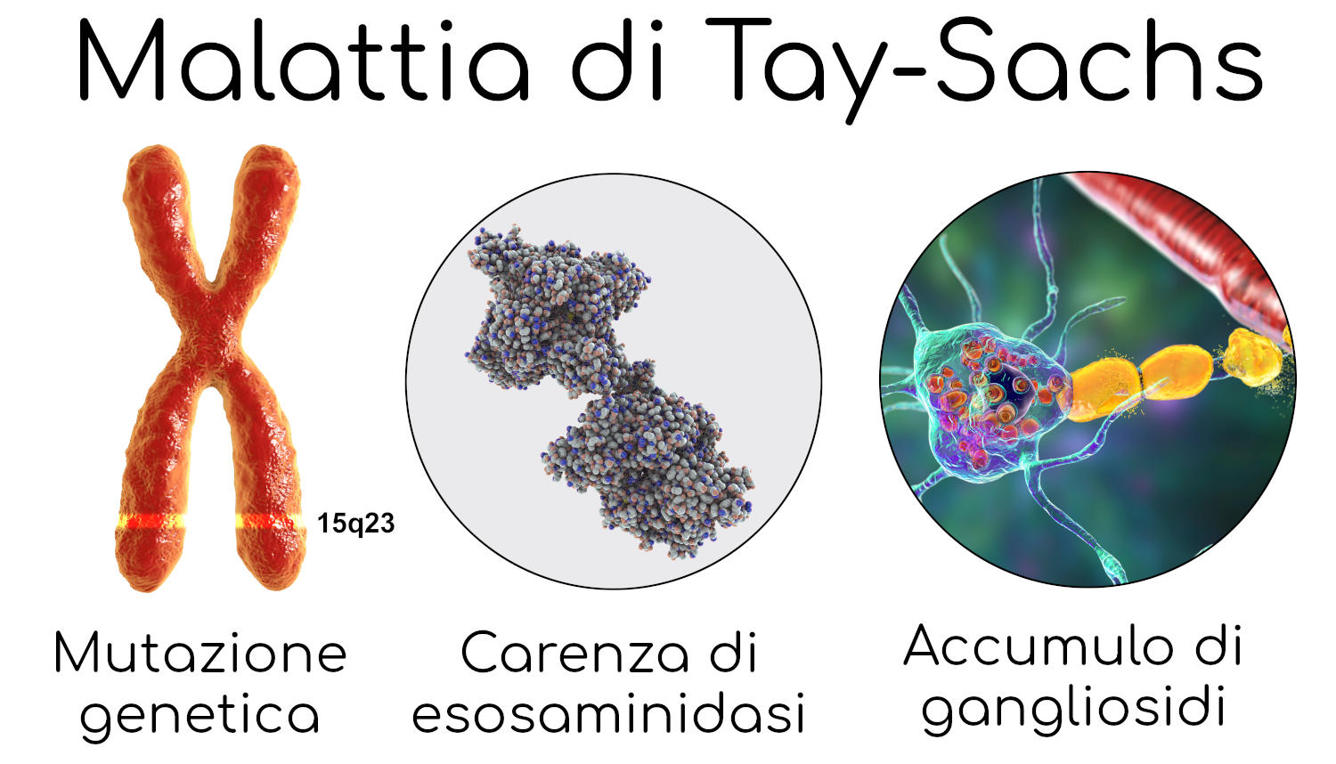 Malattia di Tay-Sachs