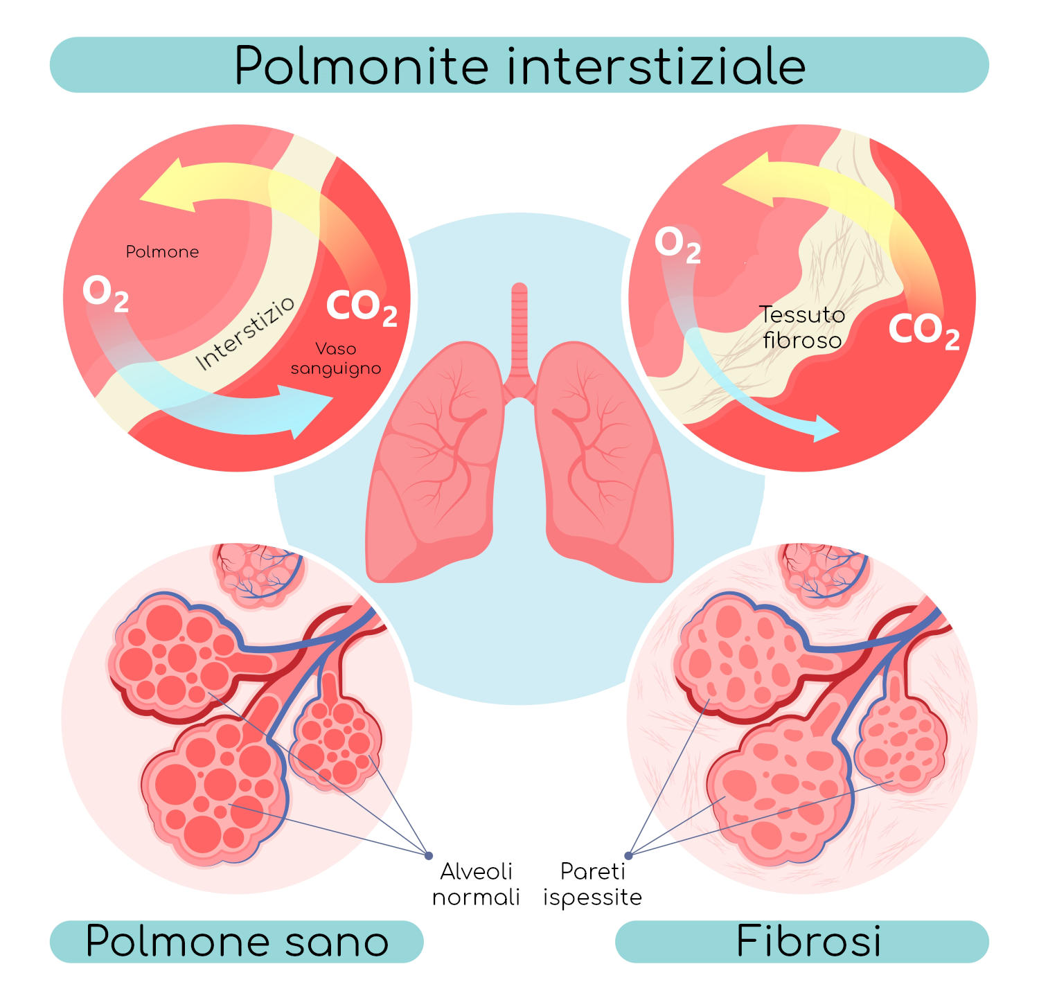 Polmonite interstiziale
