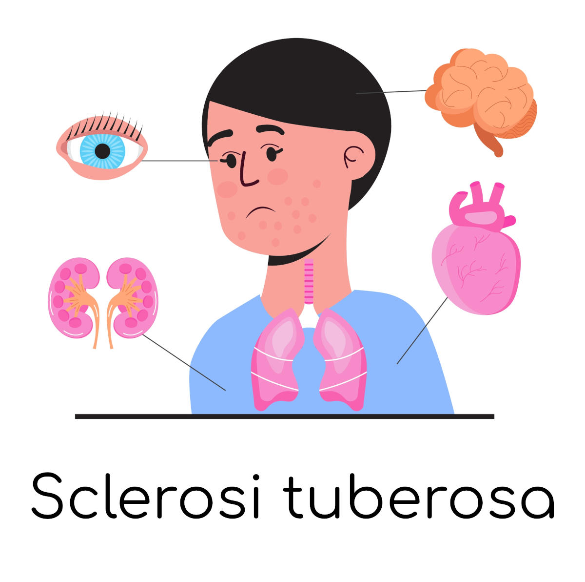 Sclerosi tuberosa