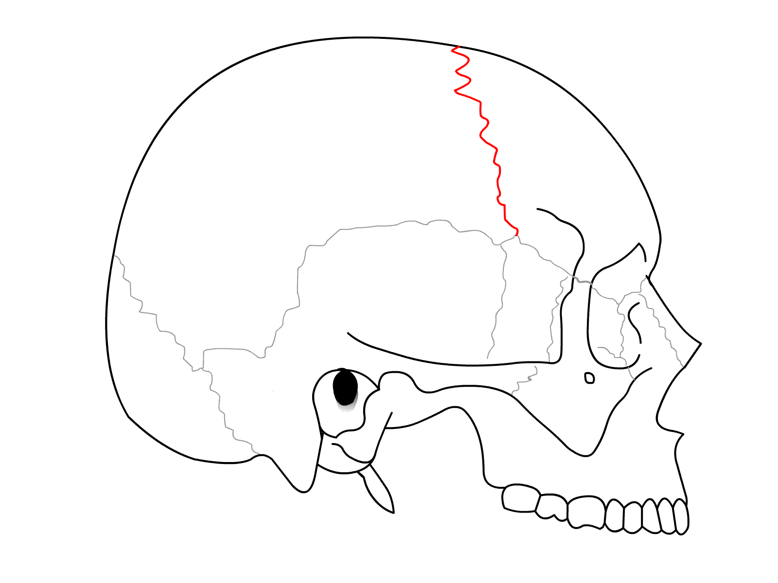 Sutura coronale