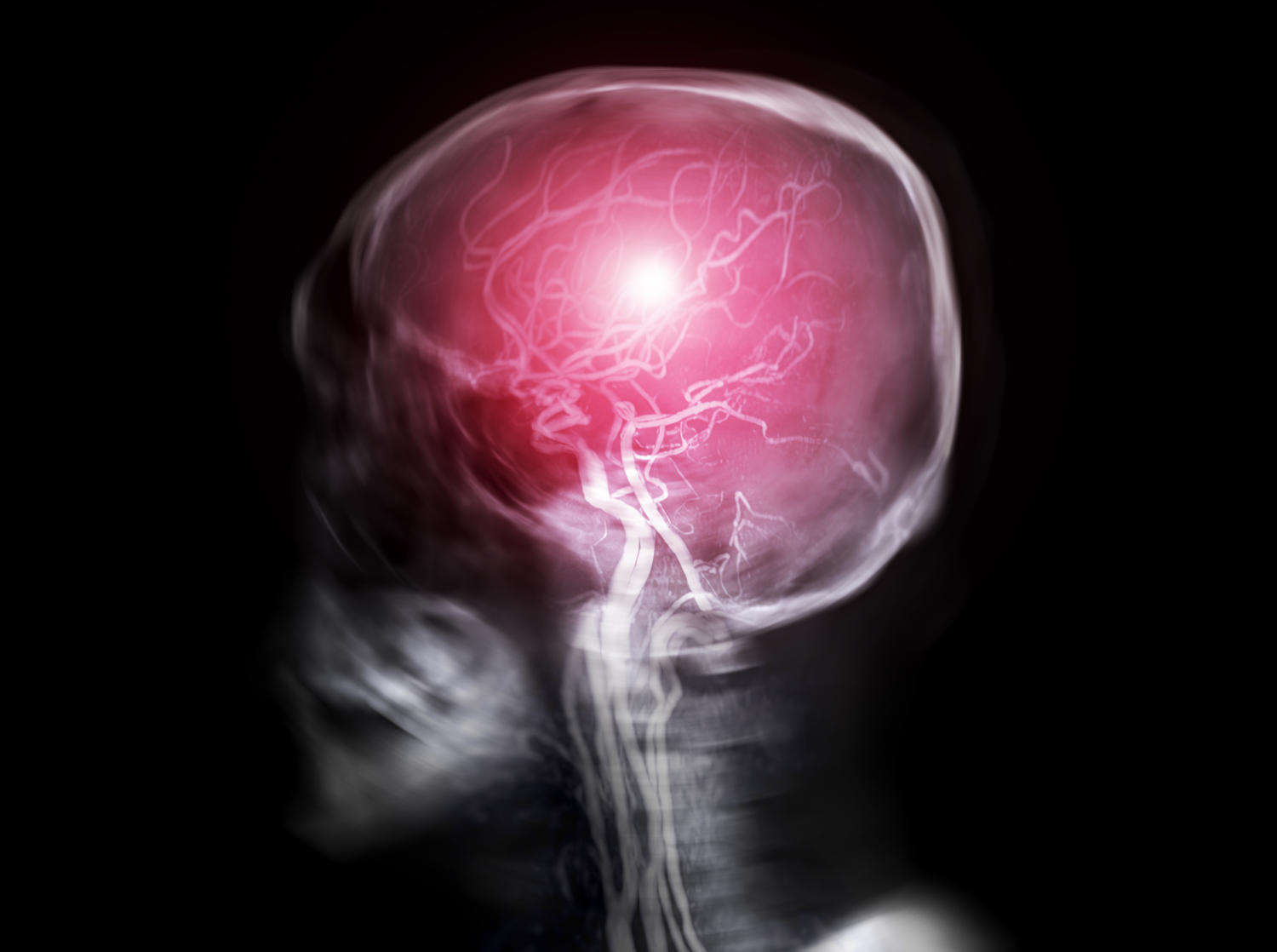 Trombosi del seno venoso cerebrale, immagine concettuale