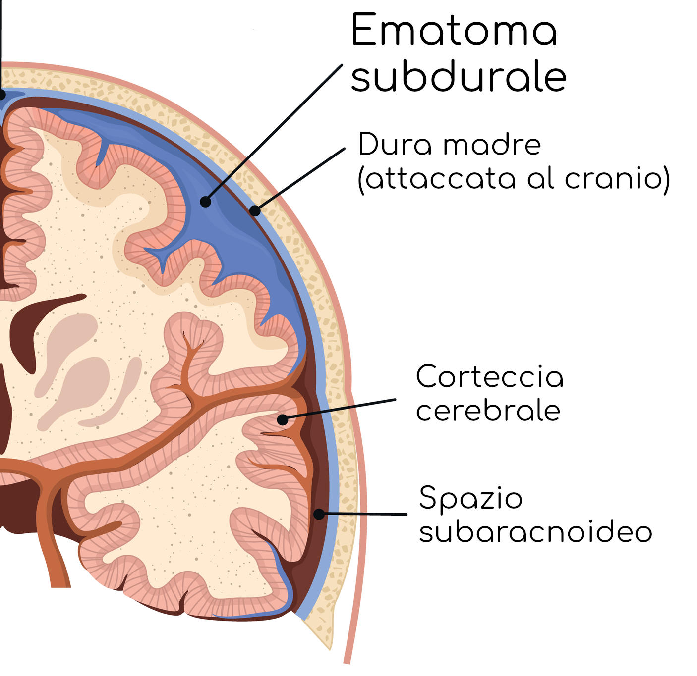 Ematoma subdurale