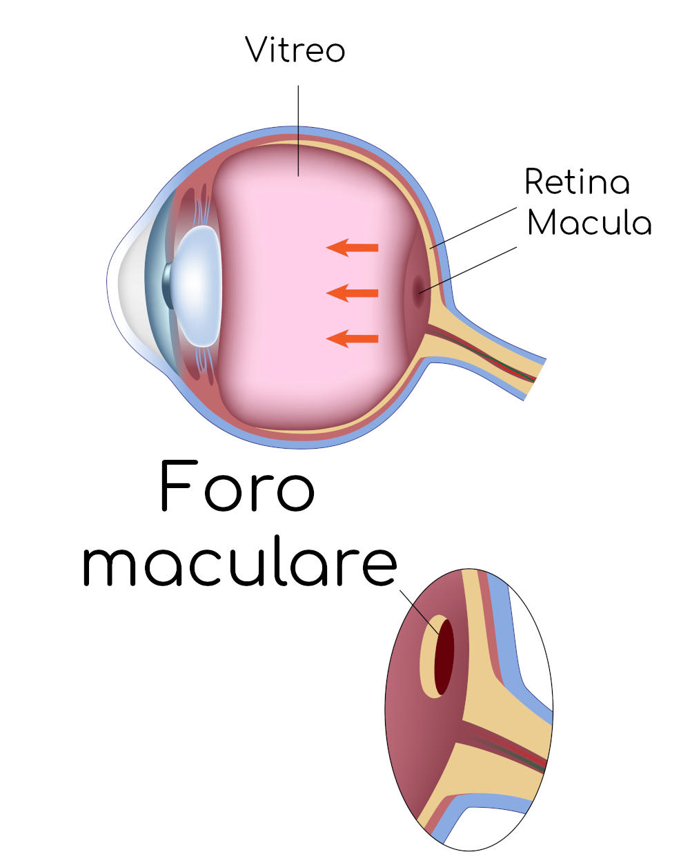 Foro maculare