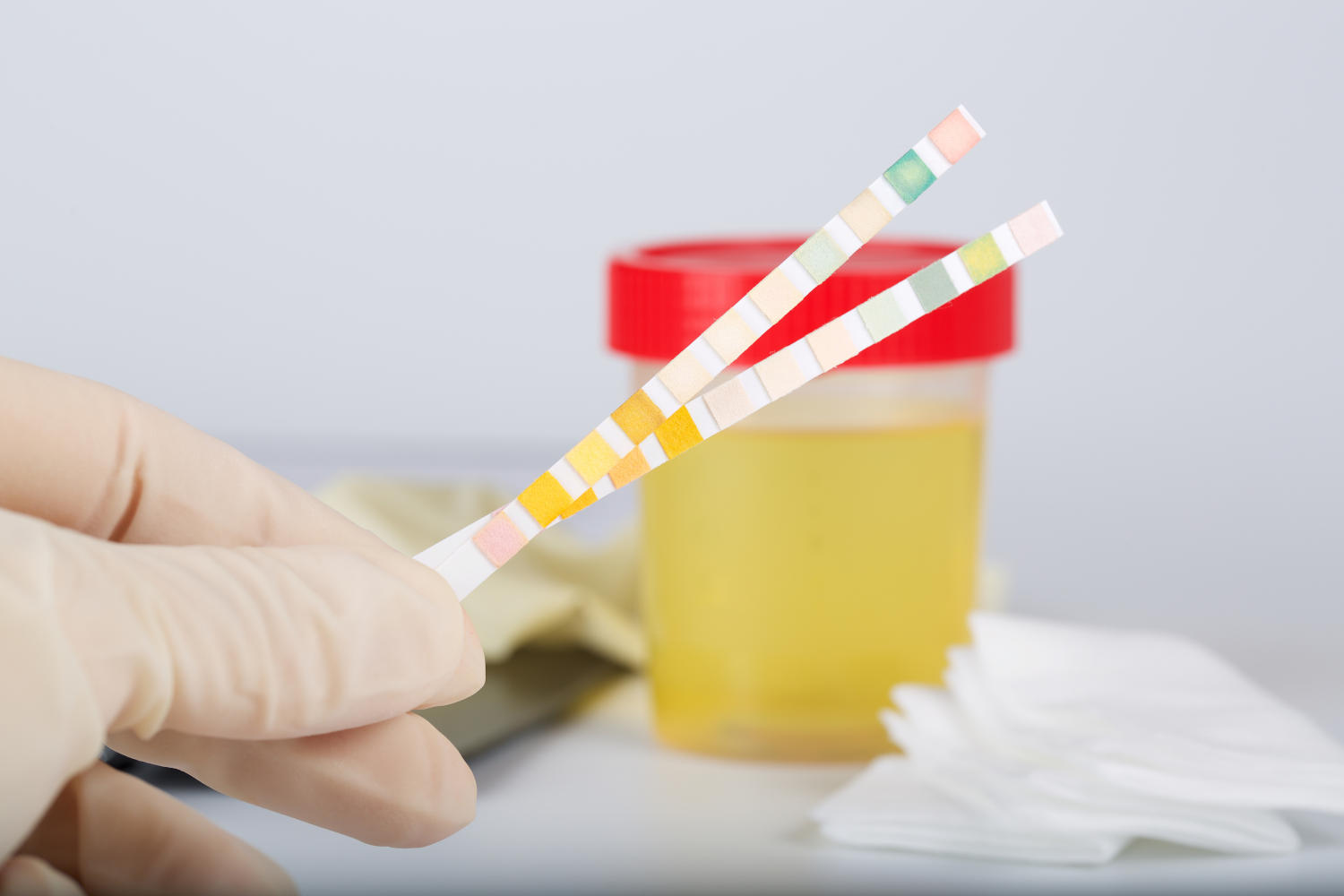 Nitriti nelle urine