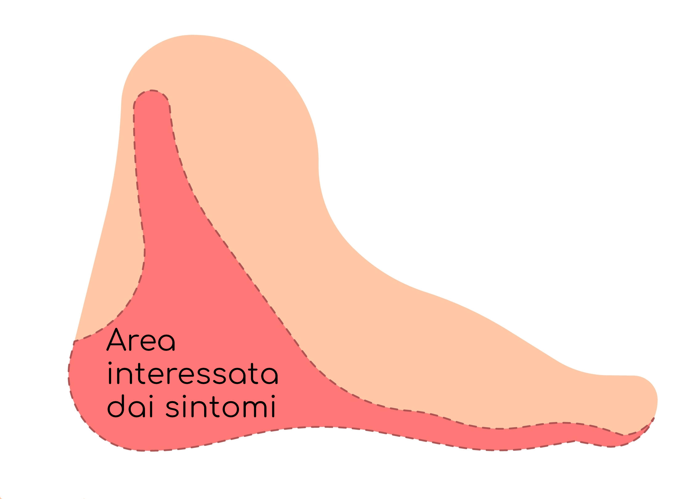 Zona di dolore della sindrome del tunnel tarsale