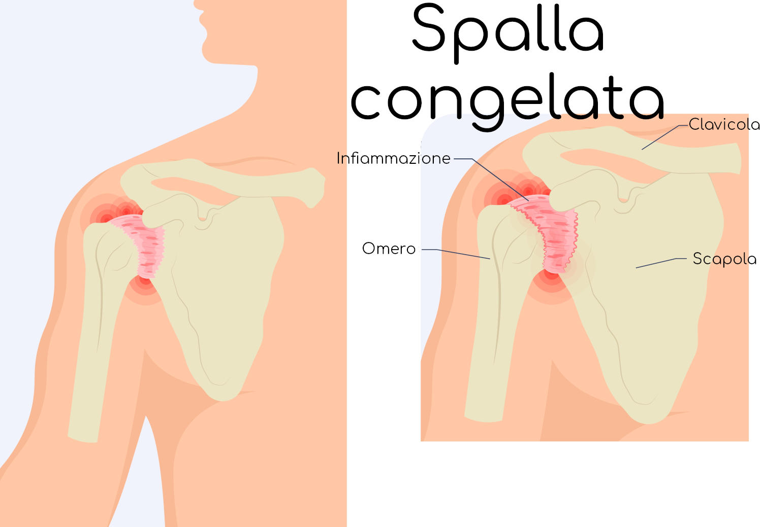 Spalla congelata