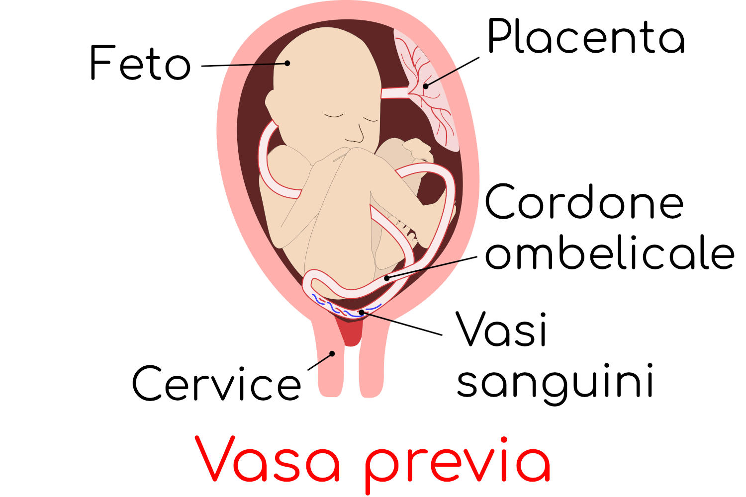 Vasa Previa