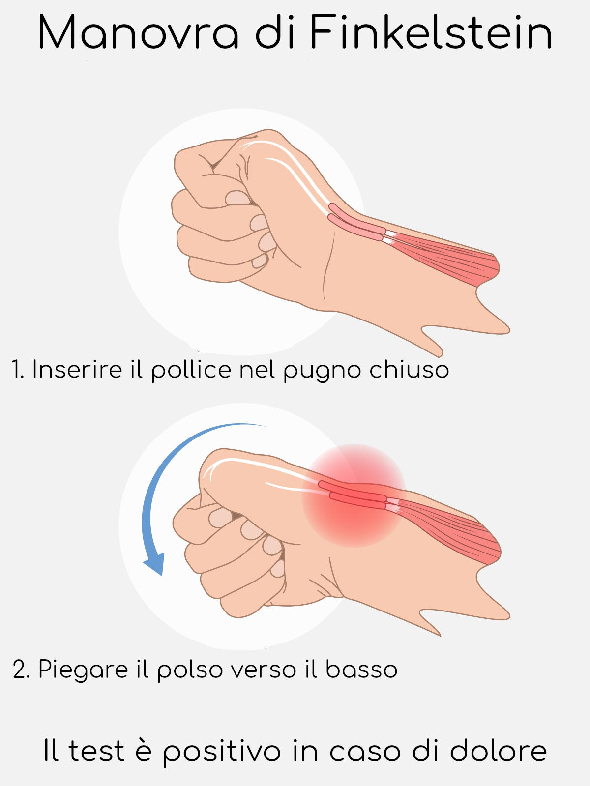Manovra di Finkelstein