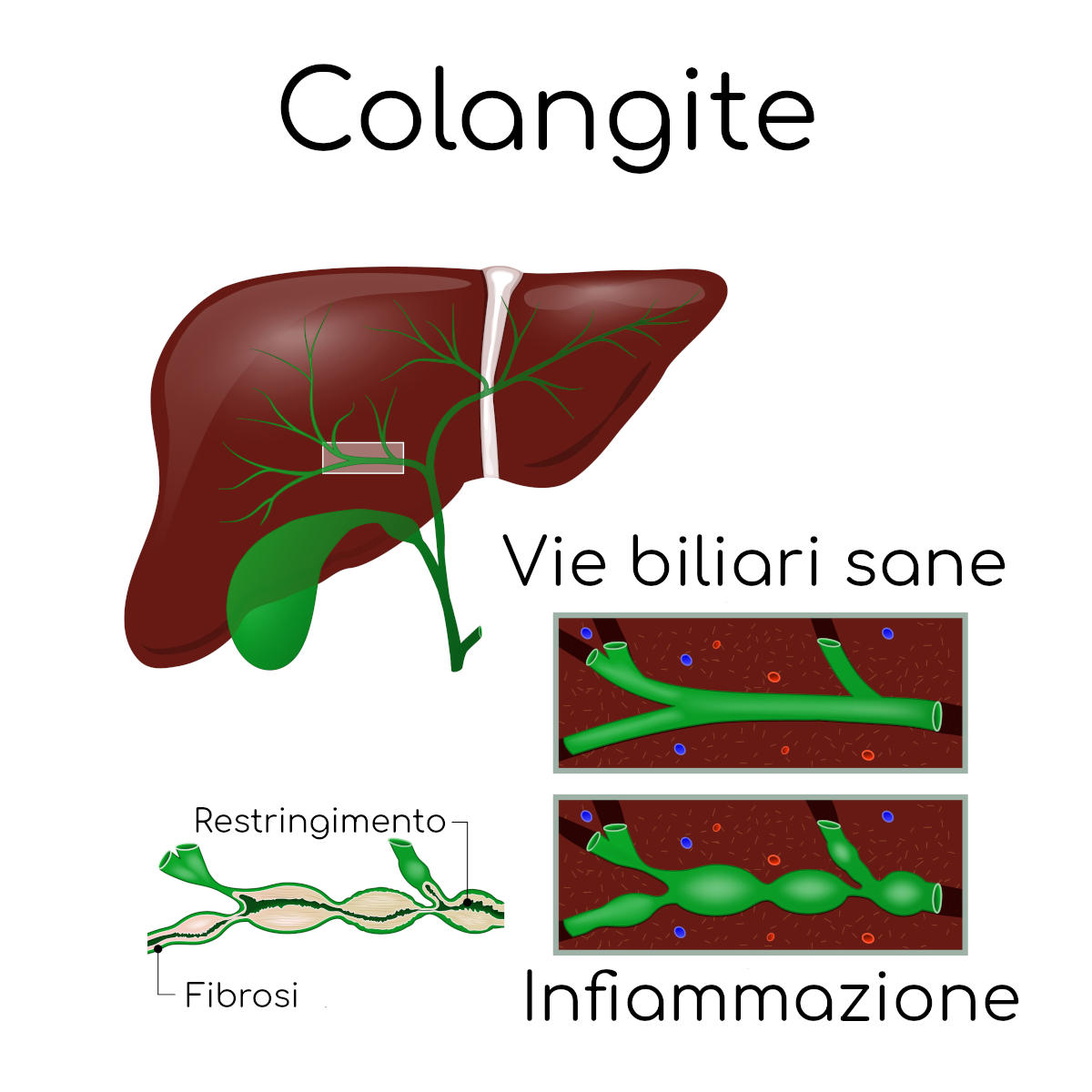 Colangite