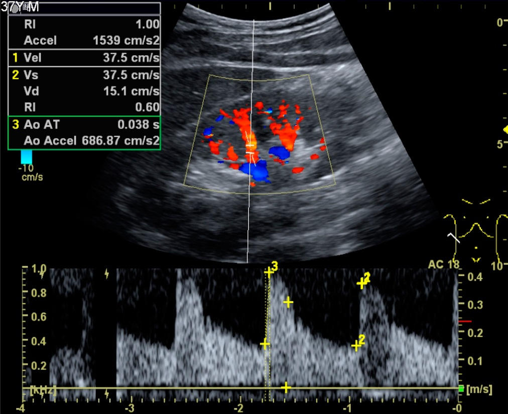 Ecocolordoppler renale