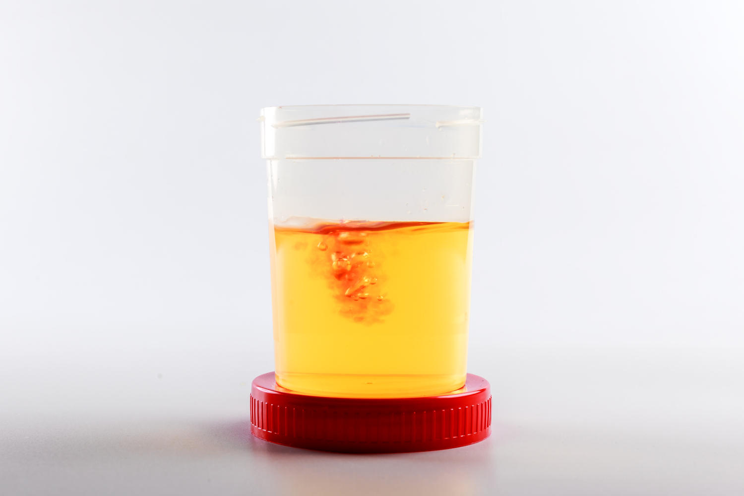 Globuli rossi nelle urine