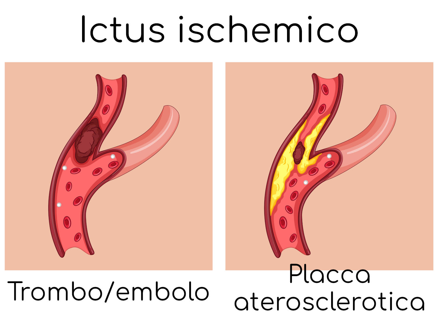 Ictus