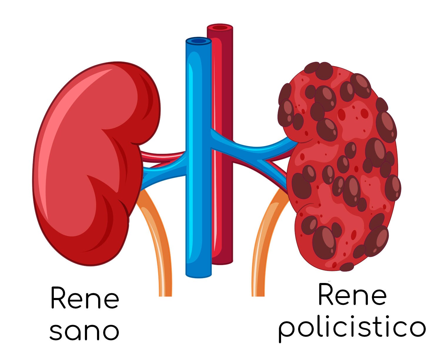 Rene policistico