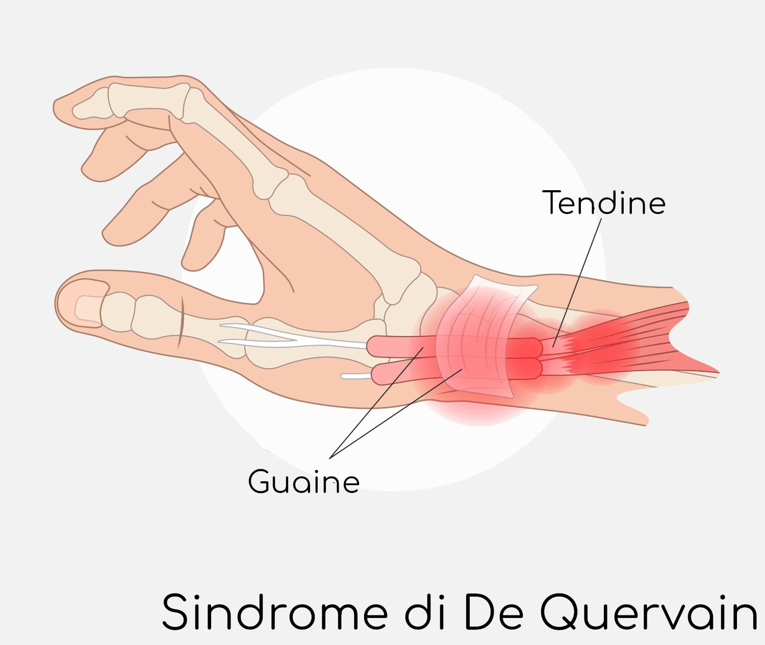 Sindrome di Quervain