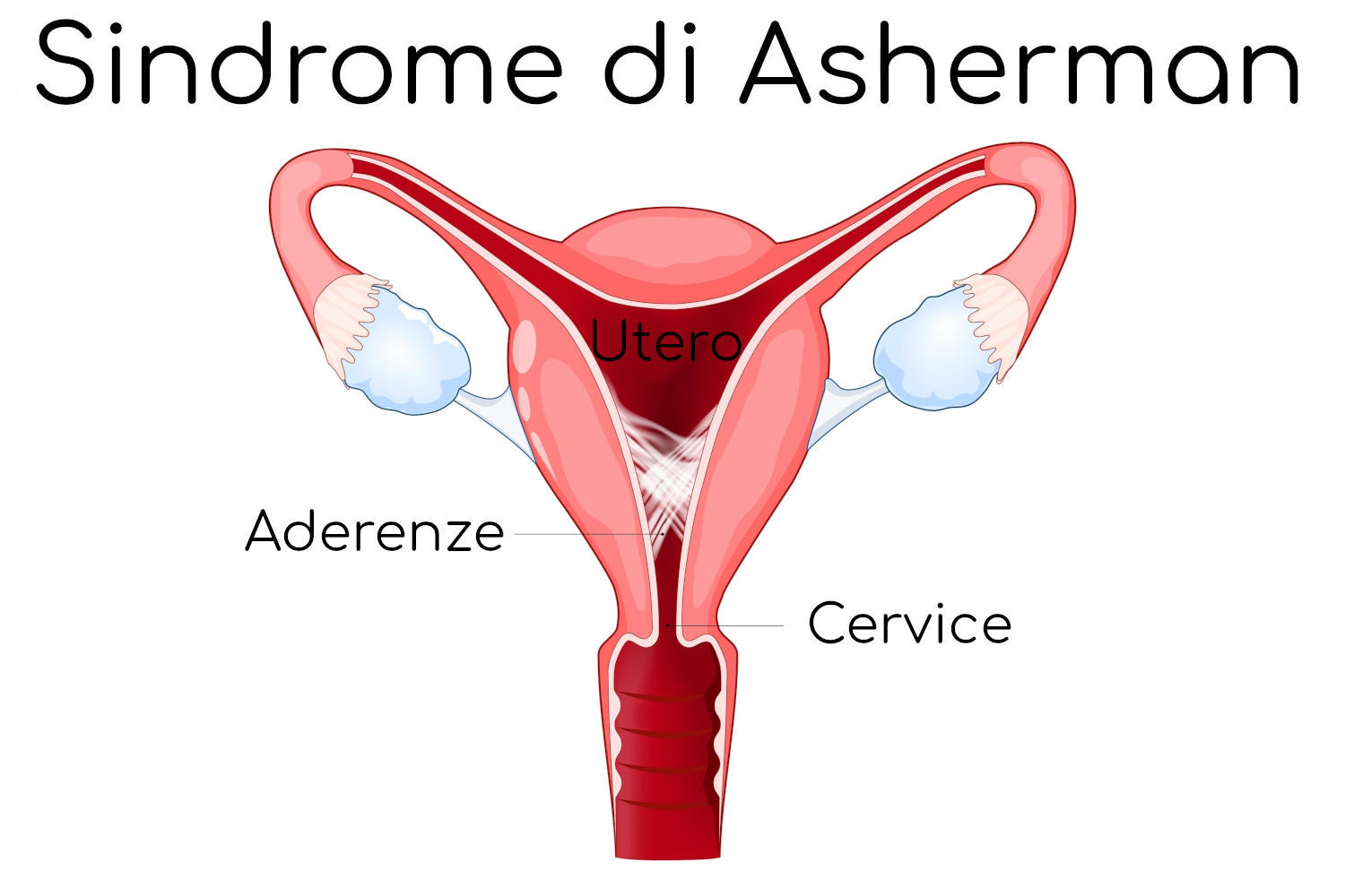 Sindrome di Asherman
