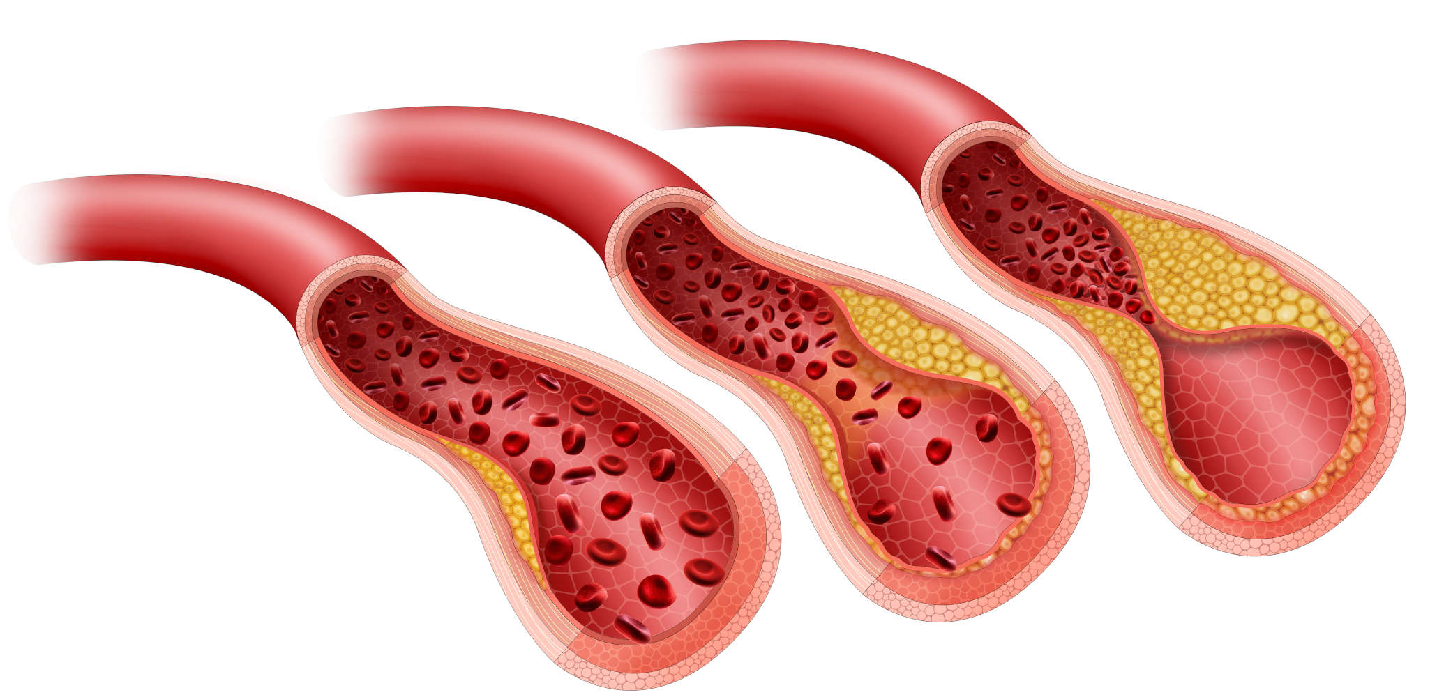Aterosclerosi