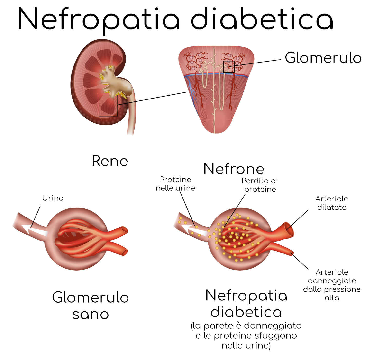 Nefropatia diabetica