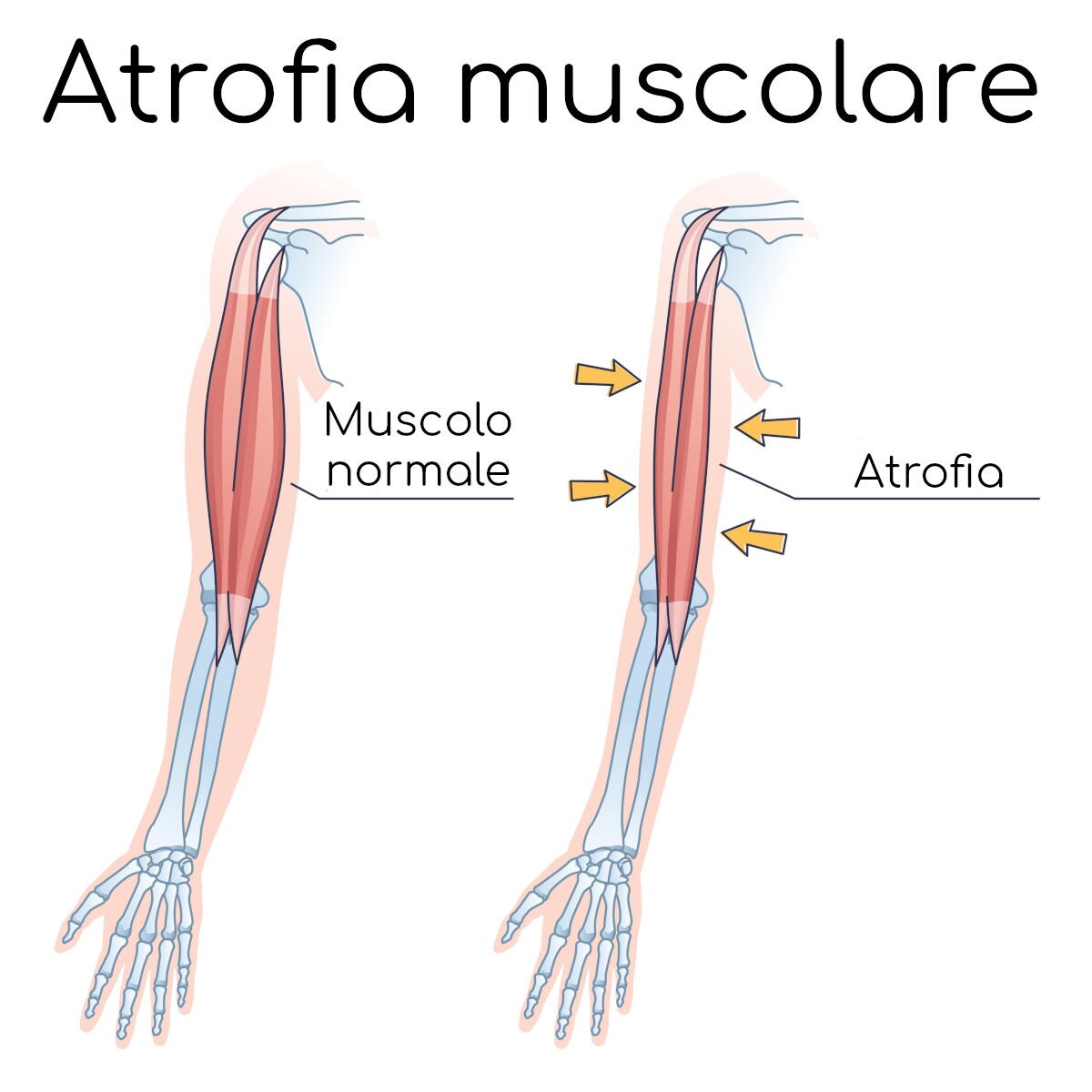 Paragone del muscolo normale e atrofico