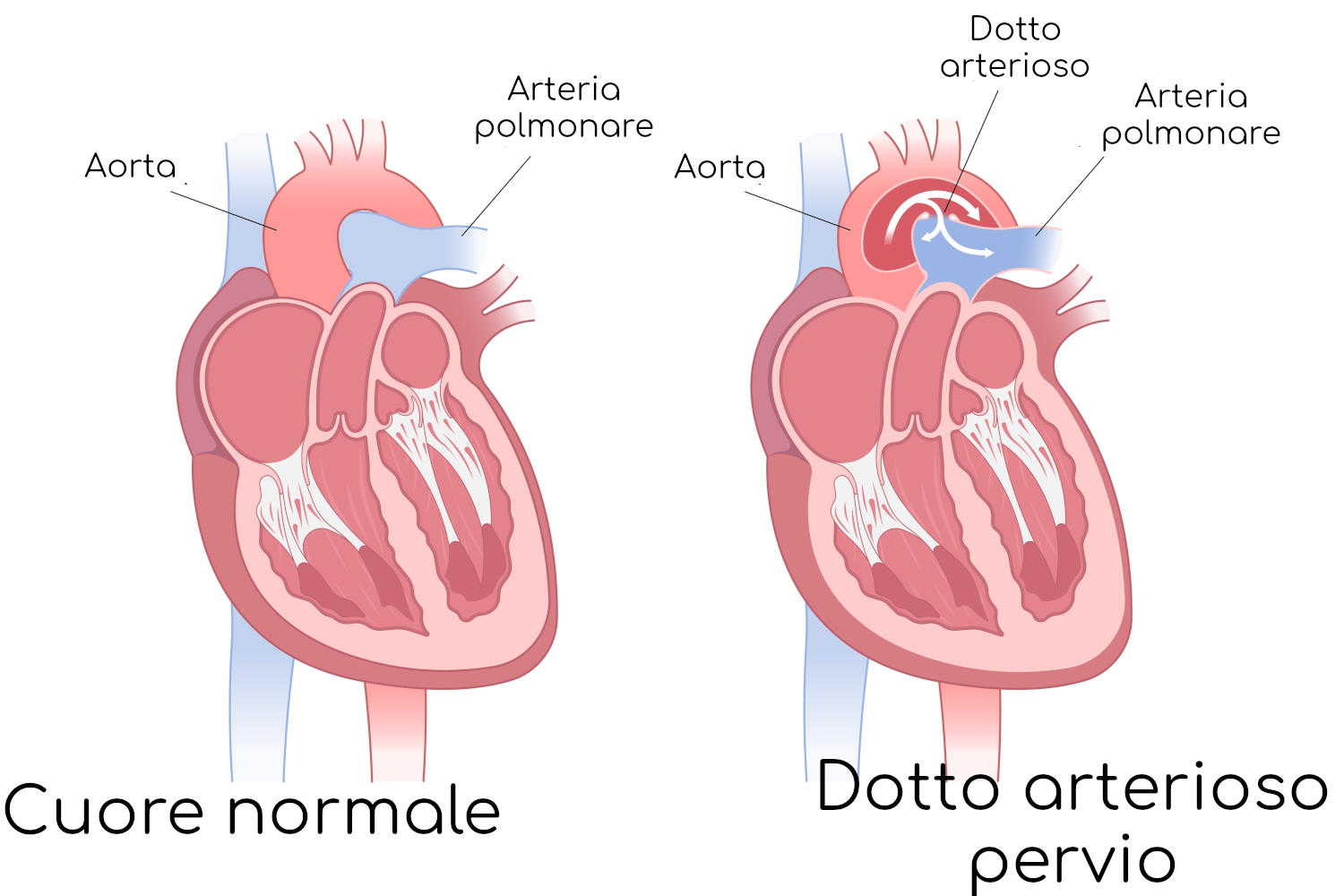 Paragone tra anatomia normale e dotto arterioso pervio