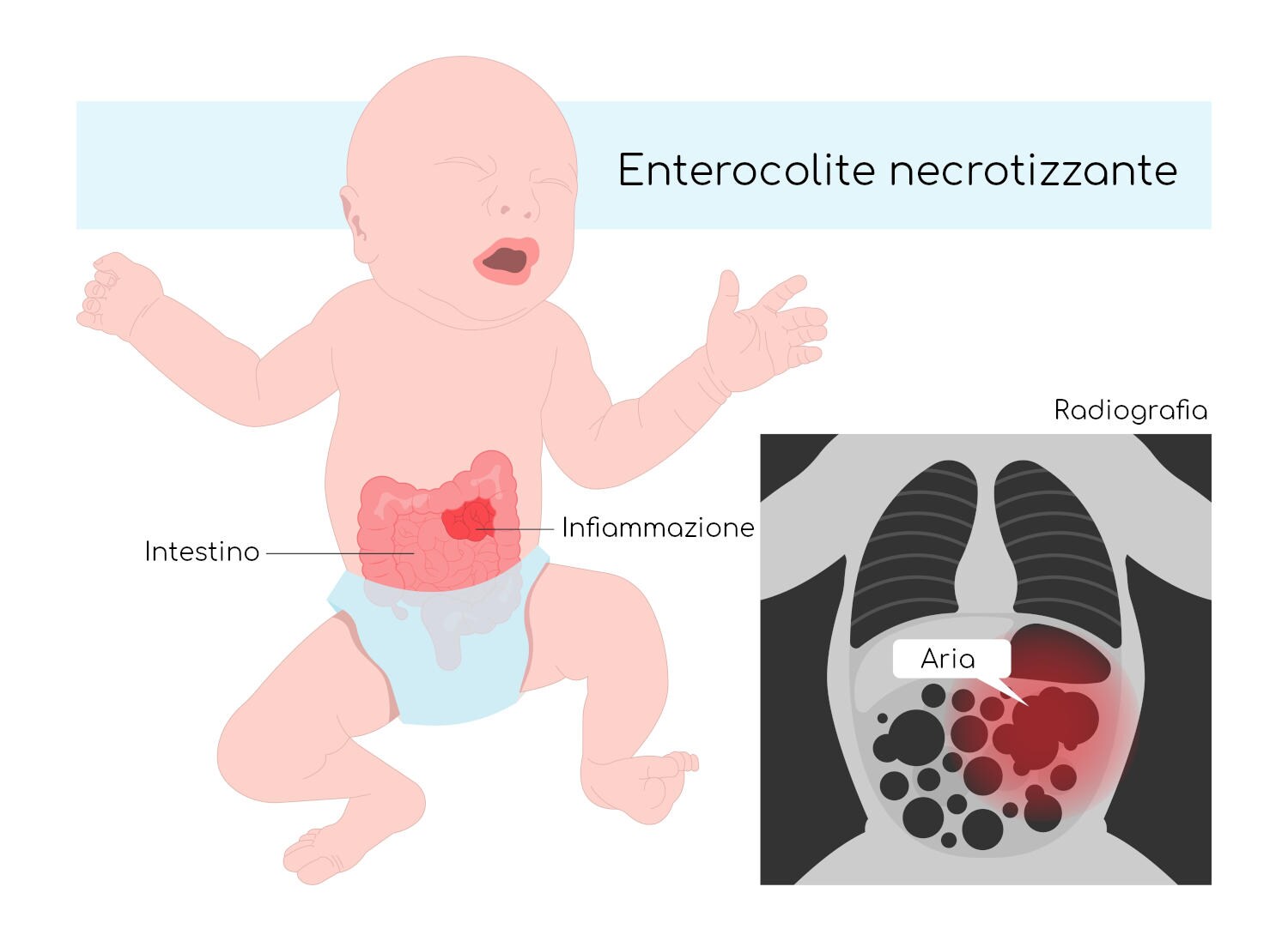Enterocolite necrotizzante