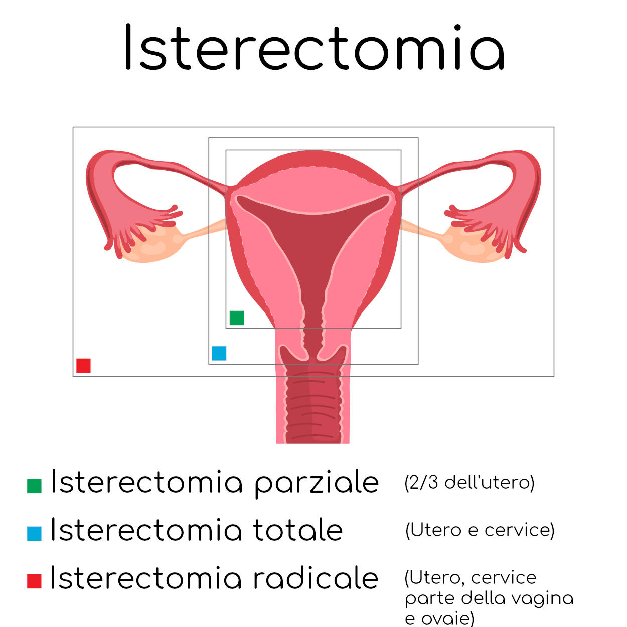 Paragone grafico dei diversi approcci dell'intervento di isterectomia