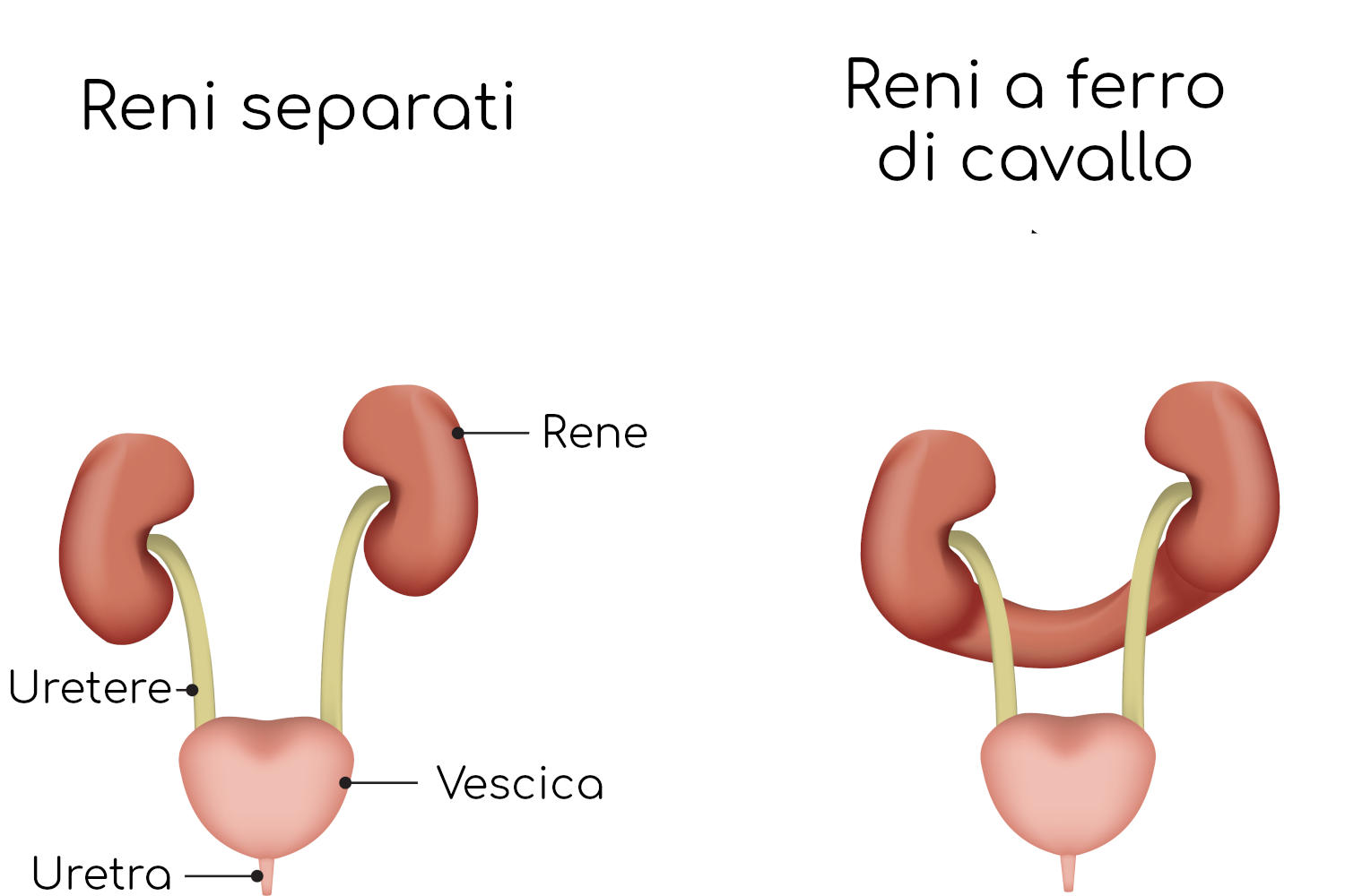 Diagramma semplificato che paragona reni normali e reni a ferro di cavallo
