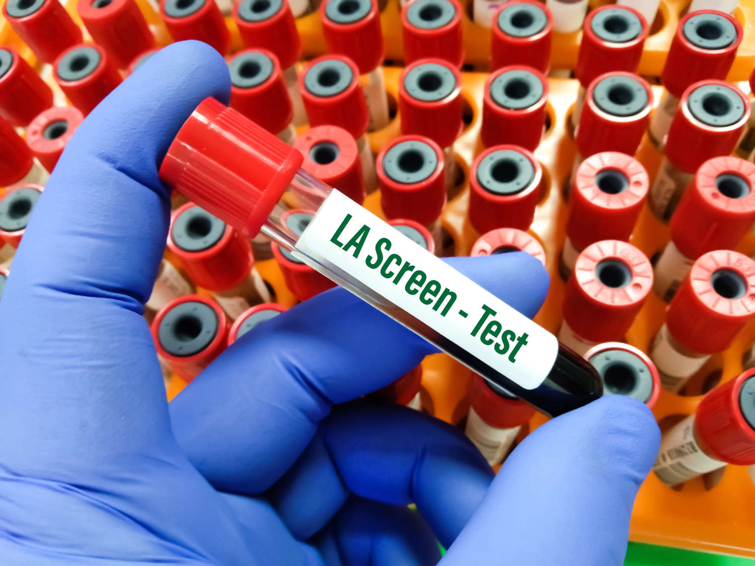 Provetta di sangue con la scritta LA Screen Test