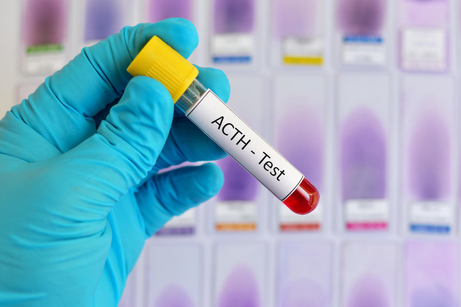 Provetta di sangue con la scritta "ACTH Test"
