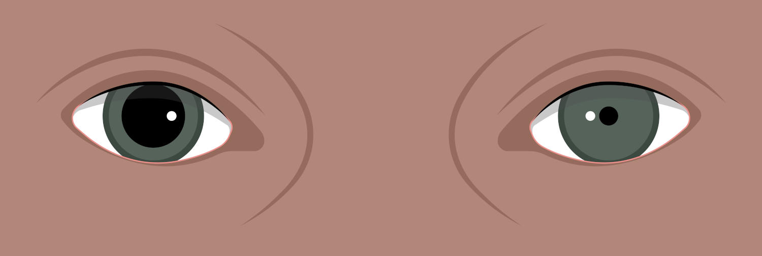Disegno con occhi che mostrano pupille di diversa dimensione