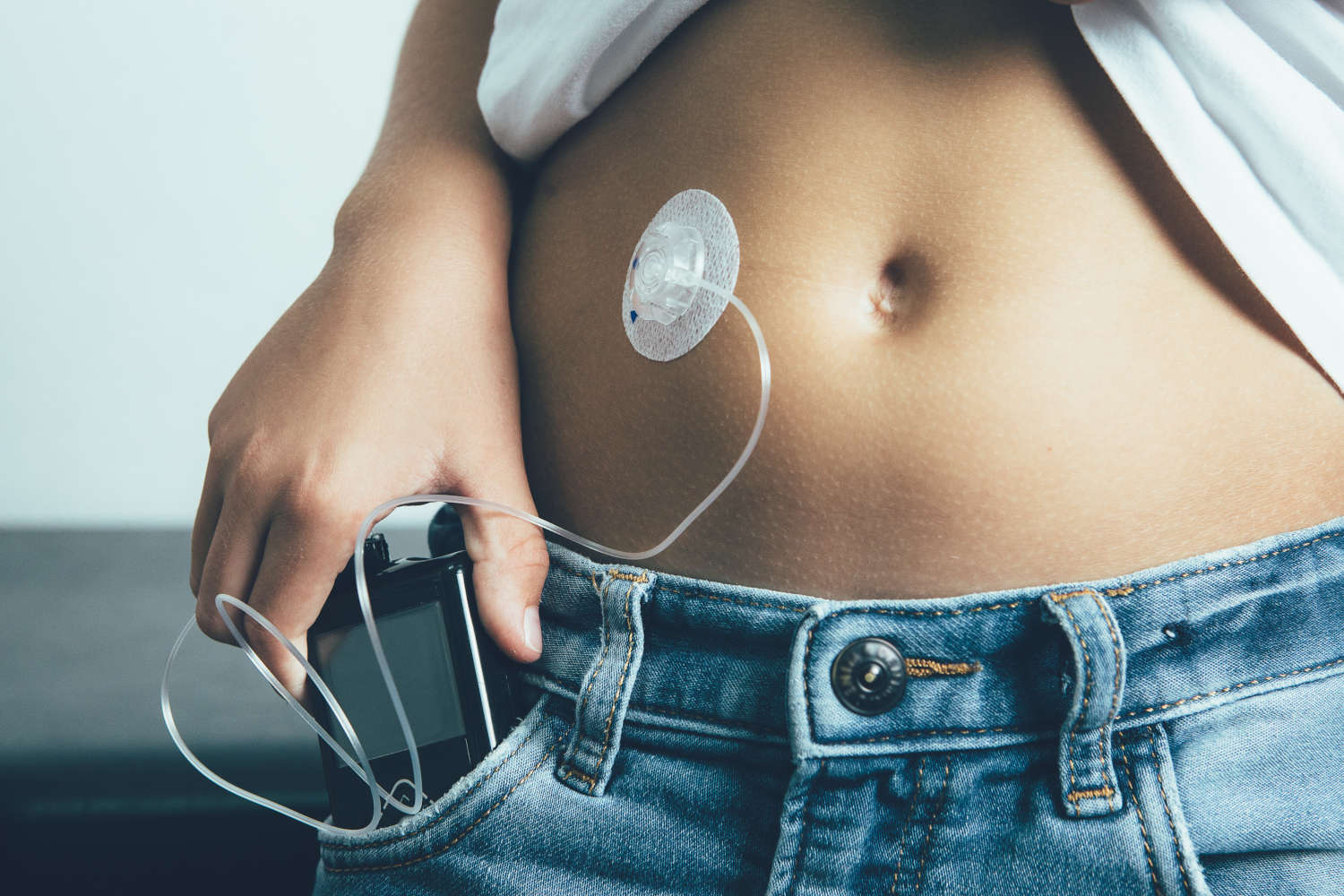 Microinfusore applicato