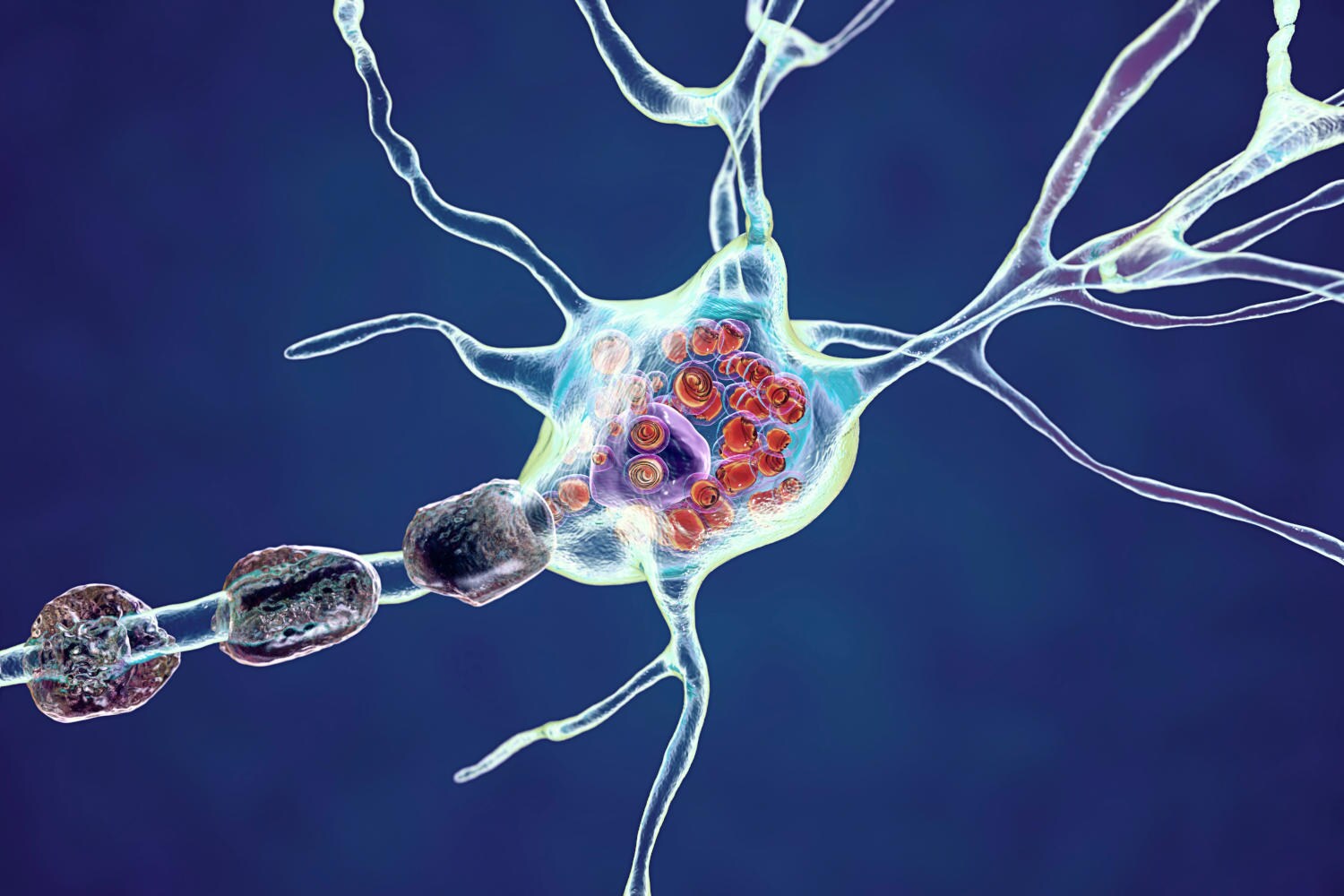 Accumulo di grasso all'interno di una cellula nervosa nella malattia di Fabry