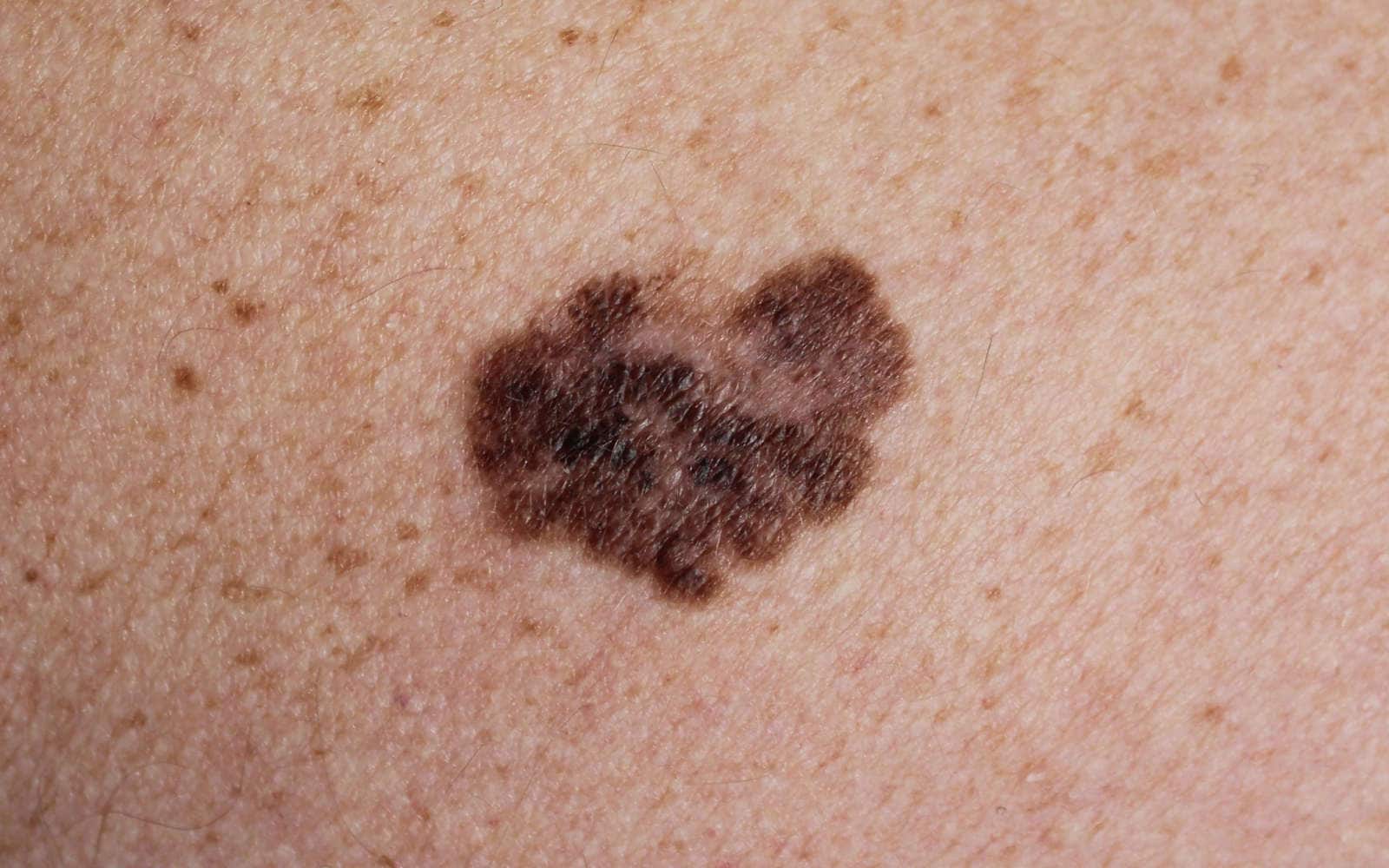Melanoma sulla pelle
