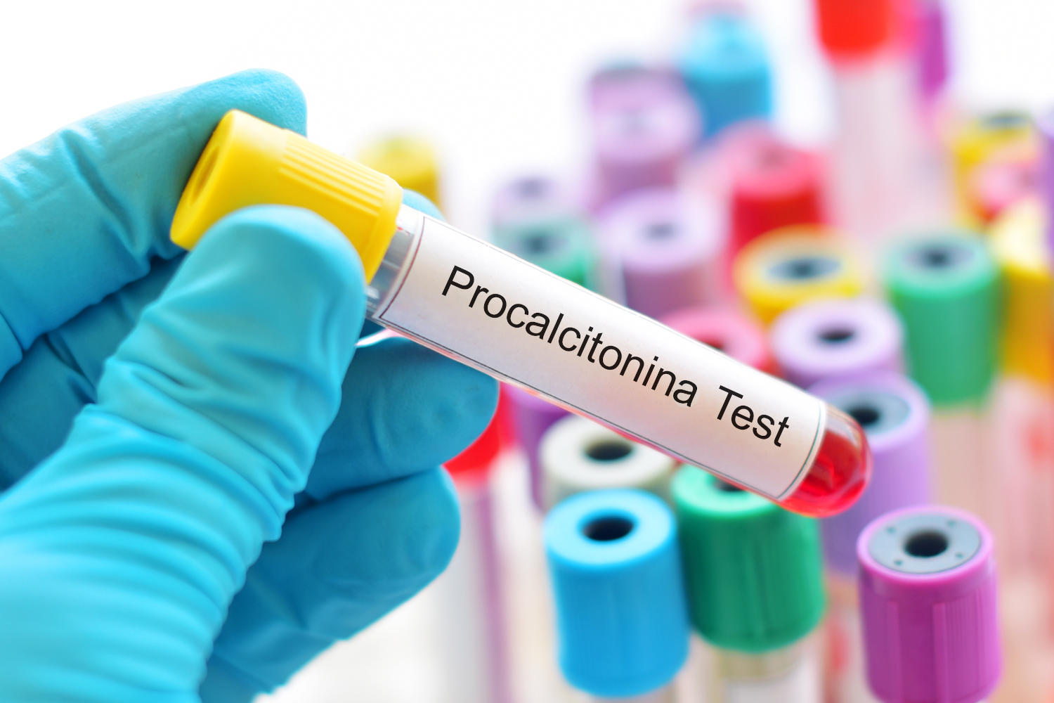 Provetta di sangue con la scritta "Procalcitonina"