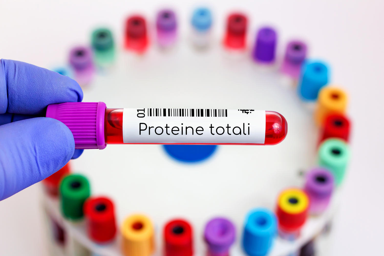 Provetta di sangue con la scritta "Proteine totali"