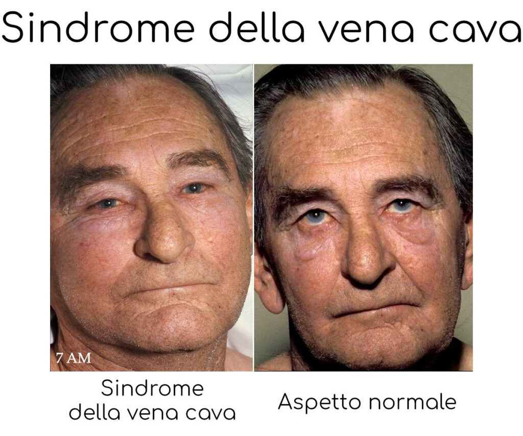Sindrome della vena cava superiore: cause, sintomi e pericoli - The Wom